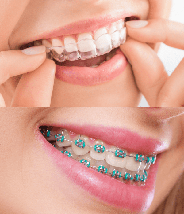 Esthetic Aligner vs Aparelho