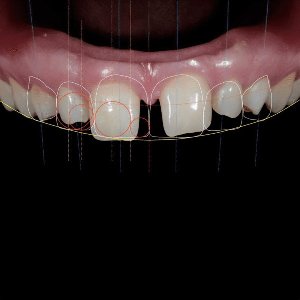 Mockup de Facetas Dentárias