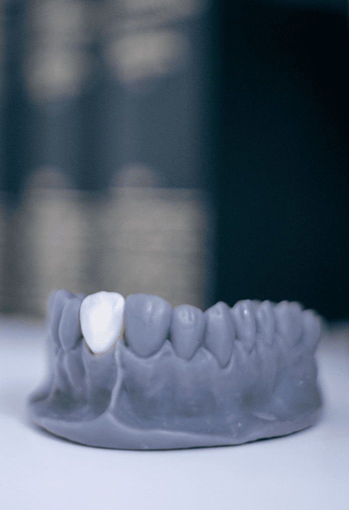 Implantes Dentários