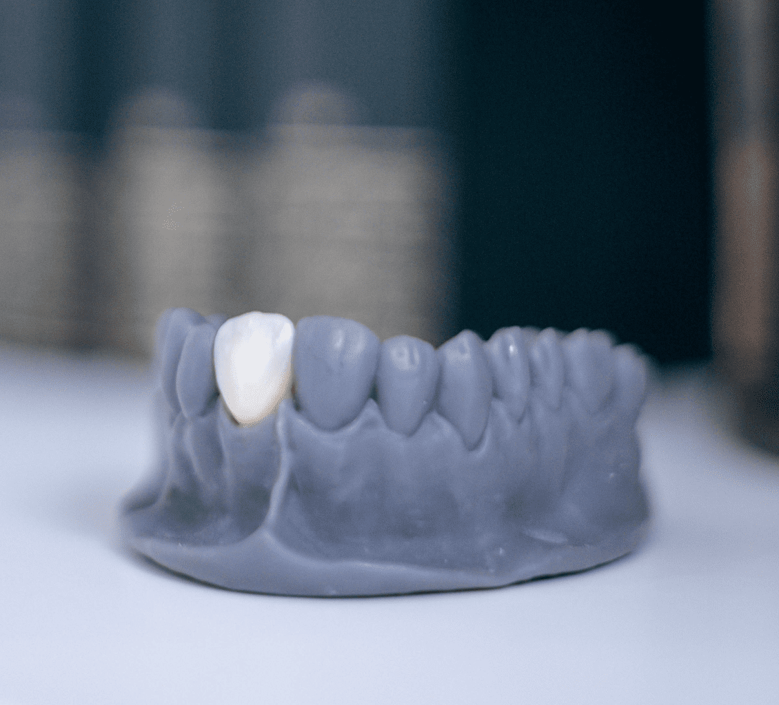 Implantes Dentários