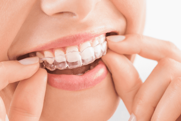 Utilização de Esthetic Aligner